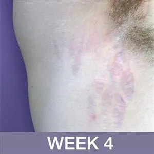 DermaSof Serum